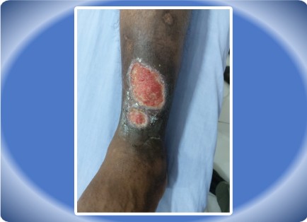 VENOUS ULCER